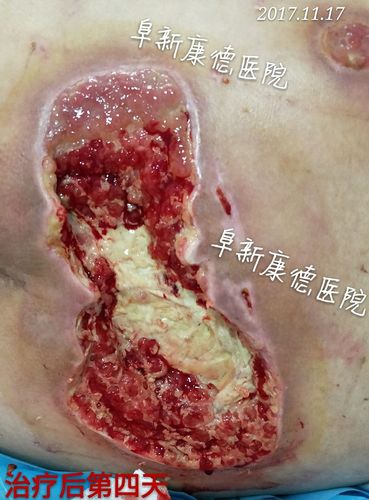 这是治疗四天后拍摄,已经有新鲜的肉芽组织生长了.