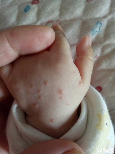 宝宝两个月 前几天手背上长的像湿疹  慢慢的变成了水泡