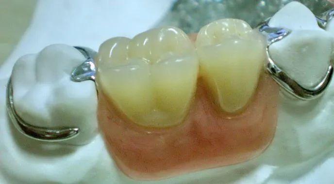 想看无挂钩假牙是怎么固定的?