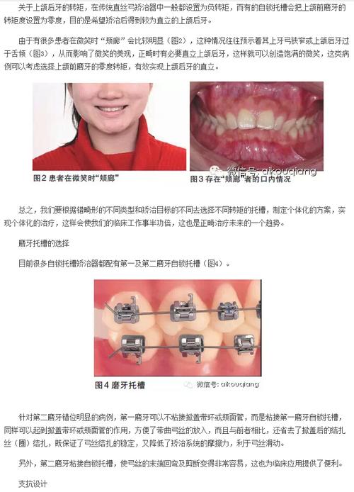 自锁托槽的临床应用