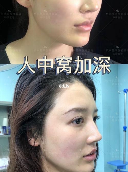 人中窝加深一点91颜值不止高一点93_唇部_西湖观景平台(湖滨银泰