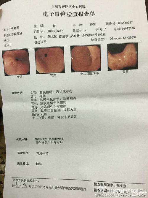 温灸筒治愈(胃角)底分化癌