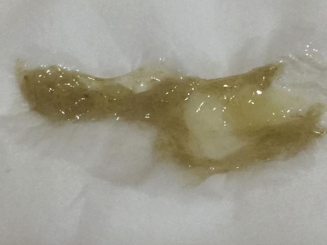 好久之前发现深咳出来的痰颜色是灰黑色.