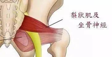 当梨状肌受到损伤时,会发生充血,水肿,痉挛,粘连等损伤性,炎性改变,这