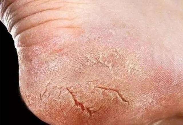 冬天脚部粗糙开裂怎麽办?老医生教你一招,脚后跟很快变白嫩.