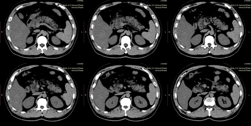 急性胰腺炎ct分级