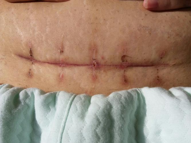 剖腹产刀口线头处有点化脓,怎么办?术后16天
