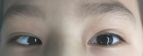 眼底照片不幸的是,孩子自幼发现患有内斜视,经过检查发现她的右眼视
