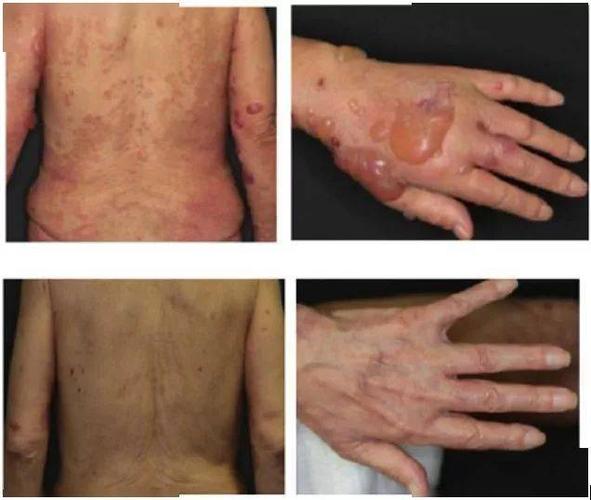 务必警惕!由dpp-4抑制剂诱发的大疱性类天疱疮