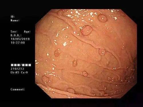 有时由于医生诊断误差,胃平滑肌瘤,胃间质瘤,肠道类癌也会被误认为胃