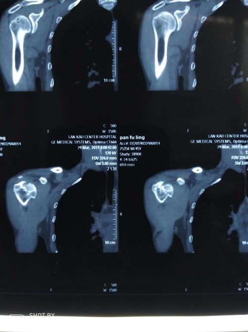 右肩ct