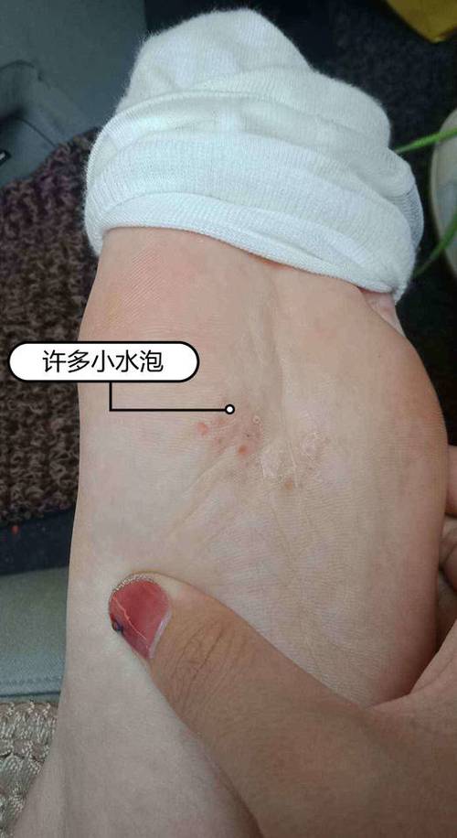 原创脚底板起了许多小水泡很痒是真菌感染吗