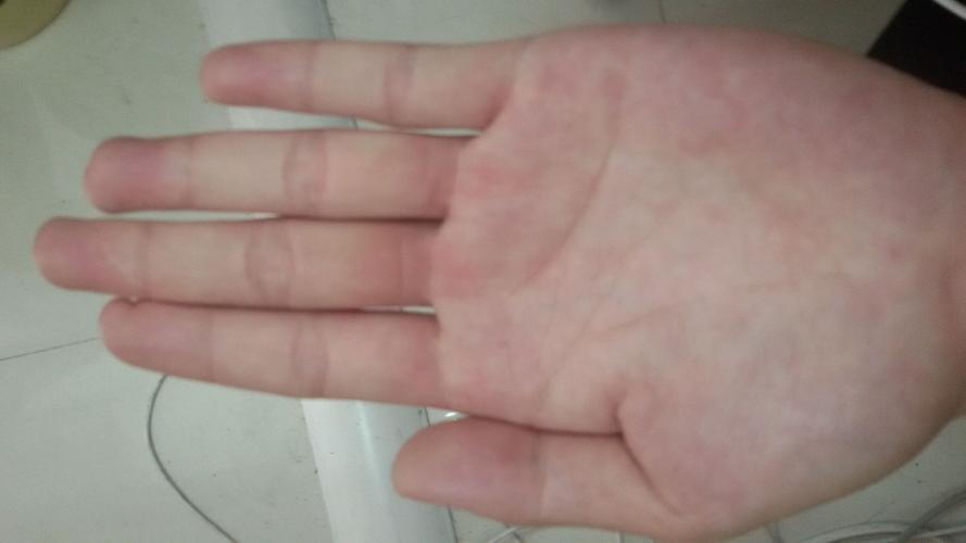 最近看到张肝掌的图片,老觉得跟我这手掌颜色有点像.