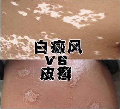 你是不是把白癜风当做皮癣在治疗?