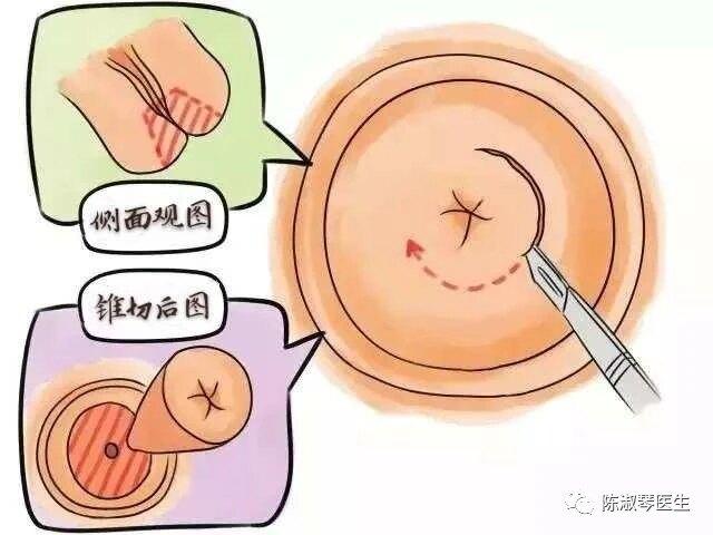 leep锥切主要是采用手术电刀来进行,称为环形电切术,英文名字是loop