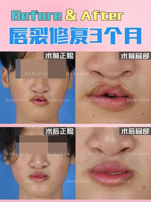 疤痕求美者,术前由于一期手术的这为修复才算一次成功的修复呢?