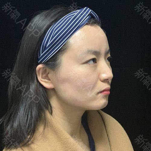 检查一下自己的肌肉,如果看着皱到了一起,就是有些颏肌紧张,注射颏肌