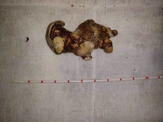 还是肾铸型结石,长得像只"鸭子"不?