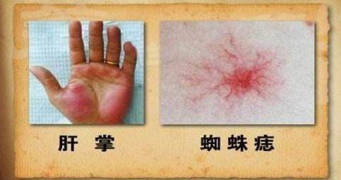 当肝癌发起攻击的时候,患者常常会有肝掌和蜘蛛痣的体征表现,肝掌