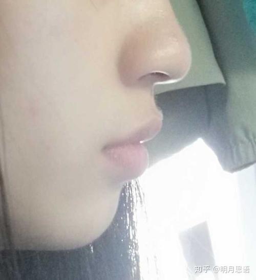 上嘴唇上翘上翻怎么办侧面看起来简直丑哭我