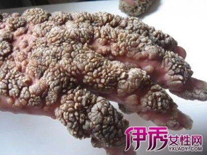 【图】人乳头瘤病毒是什么 人乳头瘤病毒感染原因你都知道吗