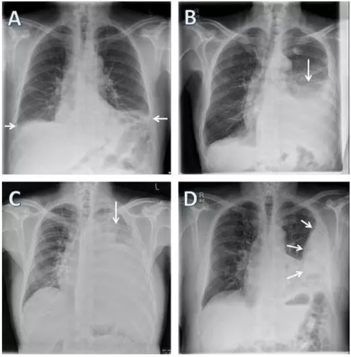 bmj胸腔积液的诊疗