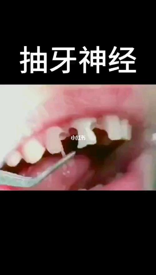 抽牙神经的过程_医疗健康_医疗健康其他