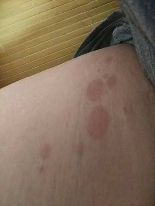 大腿内侧出了这个红色斑块,不痛不痒,咋回事?