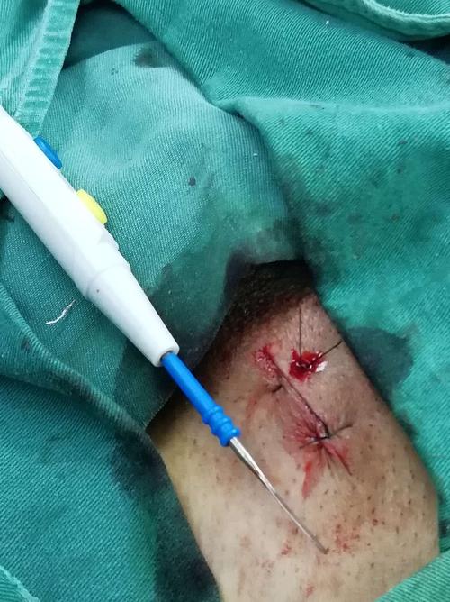 江津区中医院首例显微镜下精索静脉曲张高位结扎术