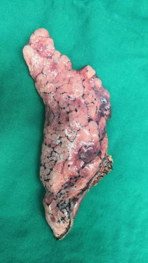 肺小结节早期肺癌微创精准切除手术,可使生活质量最大程度不受影响