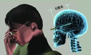 男童摔倒致眼睛被笔戳入6厘米