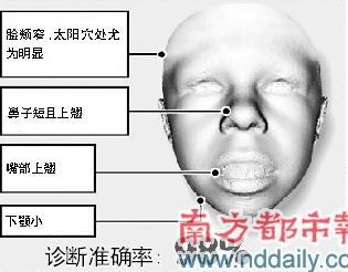 遗传病写在脸上 "相面"软件帮你辨