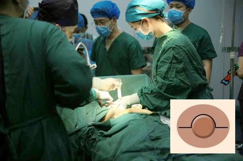 假体隆胸手术切口分为几种形式