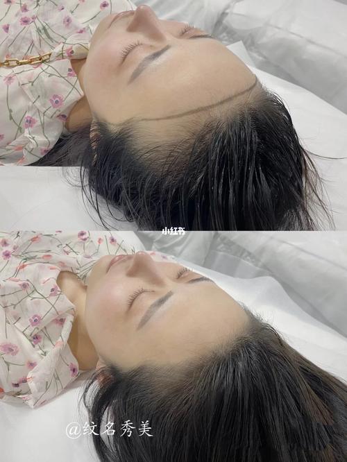 纹发际线前后对比北京纹名秀美_发际线_三里屯_装修_修饰脸型_北京纹