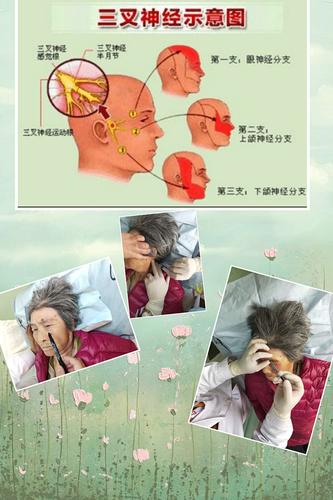 三叉神经痛俗称:天下第一痛