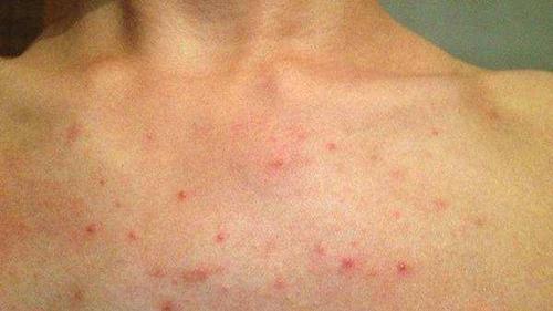 女子身上长红点,确诊肝病晚期,医生:皮肤这1变化,千万