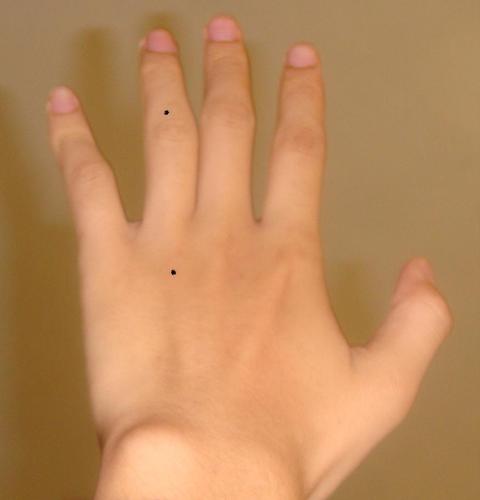 男 无名指从小长痣