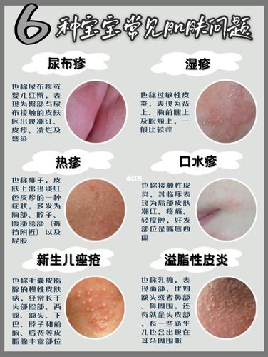 宝宝湿疹尿布疹,6种常见肌肤问题护理合集