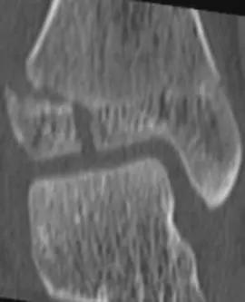 38种特殊骨折经典影像,你见过多少?