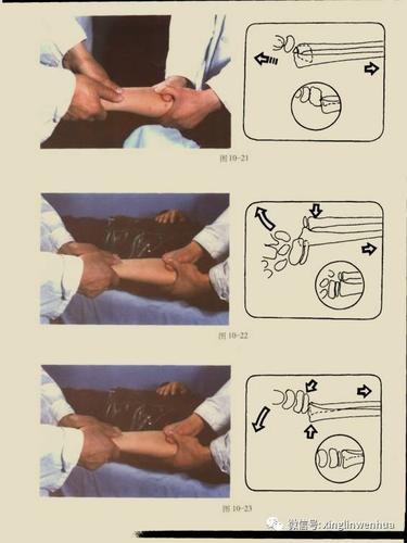 手法治腕部桡骨远端骨折