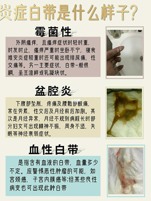 我的霉菌性阴道炎没有喽～真的开心啊!忘_阴道炎_炎症