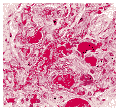 图2包囊腔中大量红细胞及不规则小的嗜复红的碎片,袢内血栓形成(pasm