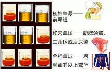 输尿管癌警惕血尿的罪魁祸首