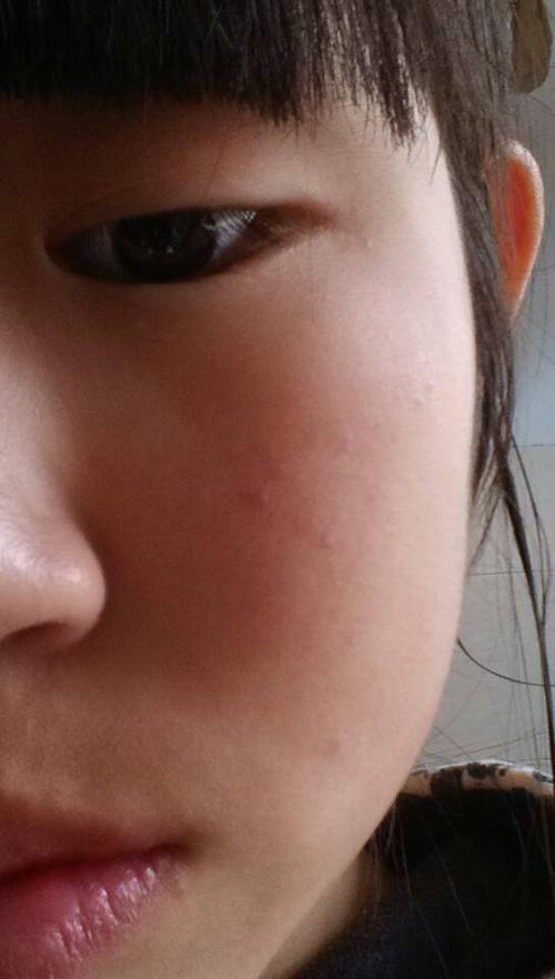 今天早上起床脸上就有好多这样的小红点了,不痛不痒