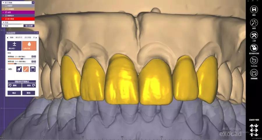 分为横纹纵纹,纵纹一般3-4条,且通常在线角内侧,如图所示 对于前牙