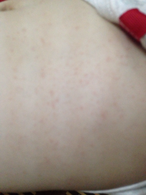 反反复复发烧,今天身上有好多小红点,是