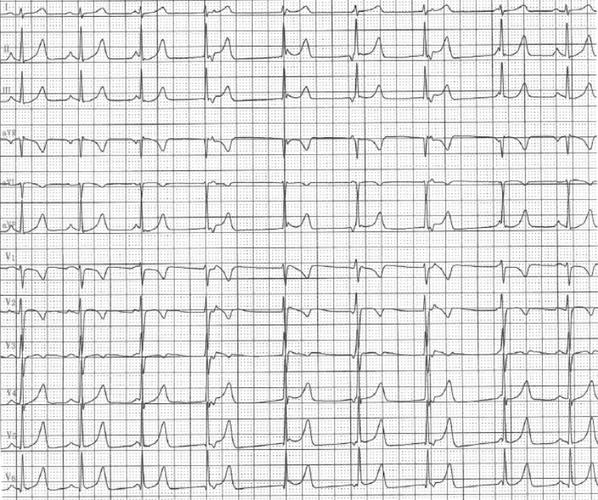 交界性心搏心律心电图301医院心电图