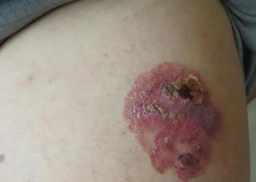 需要与银屑病,神经性皮炎,扁平苔藓等红斑丘疹鳞屑性皮肤病鉴别,尤其