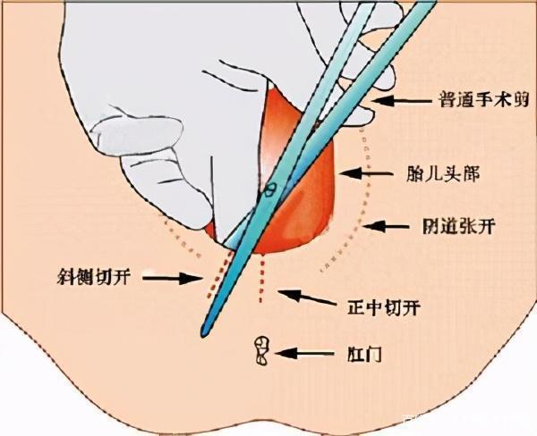 当顺产遇上侧切到底有多痛?一组图告诉你真相,网友:看着都疼