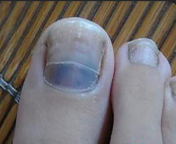 手指甲营养不良黑斑症状图片